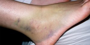 bruised ankle